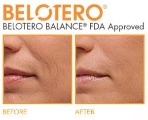 Belatero is a great filler for fine lines around the mouth.