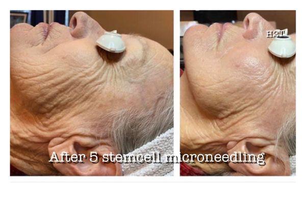 Stemcell microneedling treatment.