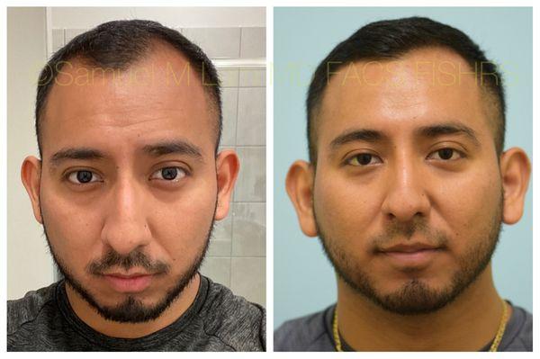 This 26-year-old man is shown before and six months after starting topical finasteride therapy for his hair loss.