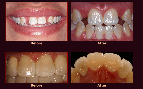 Porcelain Caps and Dental Implants