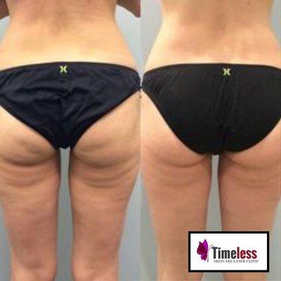 Cellulite Reduction using radio frequency