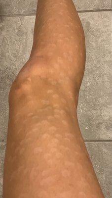 My legs months after laser hair removal