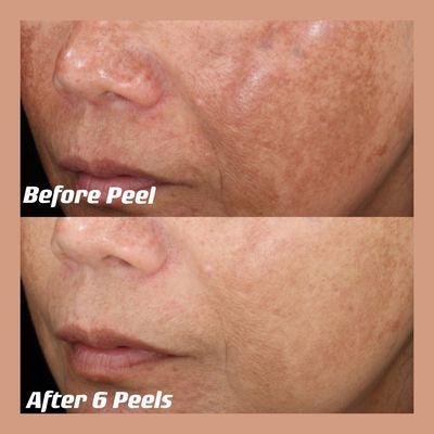 Pigmentation Solutions/Aging Facial/Peel
Sun exposure /Hormone Fluctuations/ Inflammation/Melasma Wrinkle