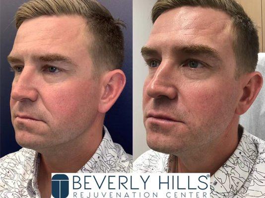 Male Full Face Liquid Lift Before and After