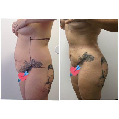 Before and after mini tummy tuck with Liposuction