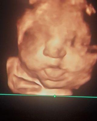 InVision 3D4D Ultrasound