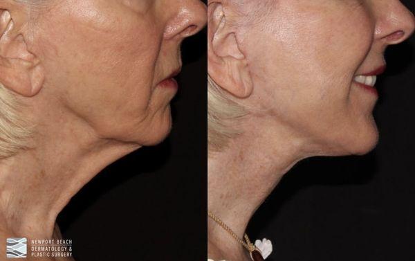 Secondary facelift by Christopher Ellstrom, M.D.