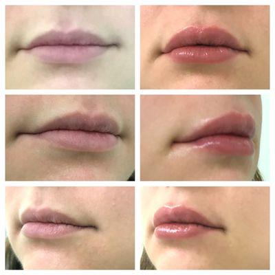 Restylane Lip Filler