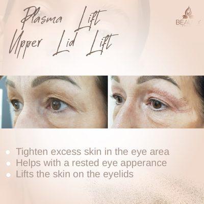 Plasma Fibroblast Skin Tightening Upper Eyelids