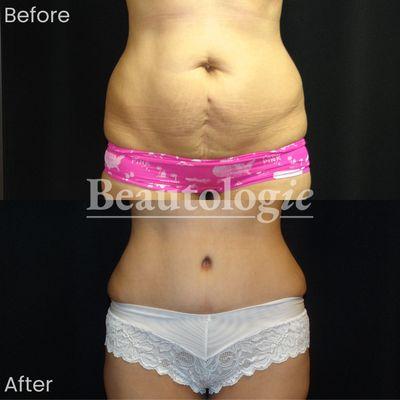 Tummy Tuck Before and After