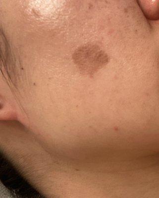 The hyperpigmentation from the skin peel burn she gave me in my 20s.