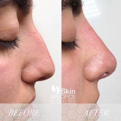 Non surgical nose augmentation using dermal filler