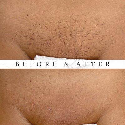 What 1 year of Waxing can look like. It is never too late to start.