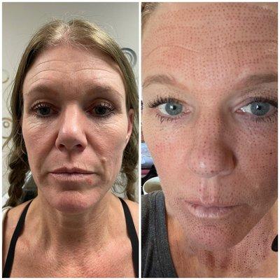 Fibroblast full face before and two days later....non invasive skin tightening