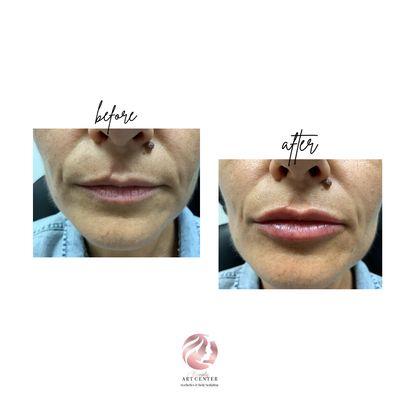 Lips Fillers