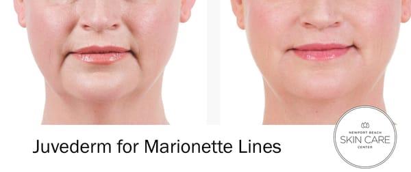 Juvederm for Marionette Lines