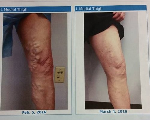 Before and After Radiofrequency Ablation for varicose veins.