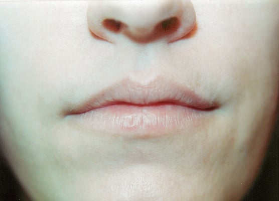 Natural Lip (Before)