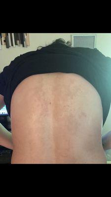 This is my back after tanning two weeks at NATIVE SUN TANNING AND SPA. Looks like a skin fungus