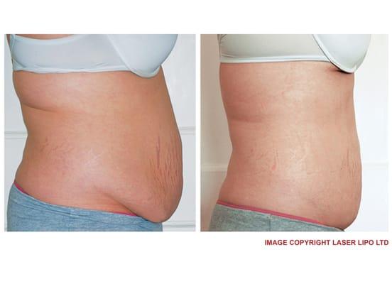 Before and after non-invasive, painless laser lipo, eight - 20 minute treatments.