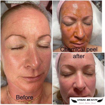 Chemical peel