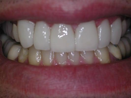 After Veneer