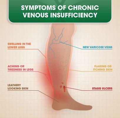 Do you have any of these symptoms? If you do, you may have chronic venous insufficiency and need to see a doctor for relief.