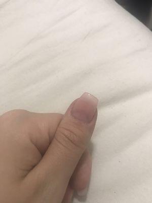 Crooked thumb nail!?