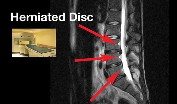 We treat many spine related diseases including herniated discs