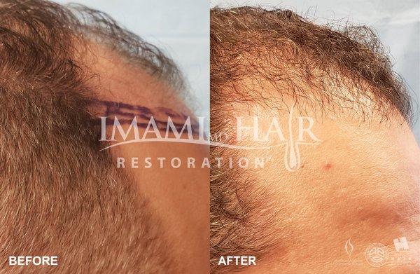 Patient 113040: 38 year old male.  FUE for Hairline reconstruction and fill to Crown with PRP