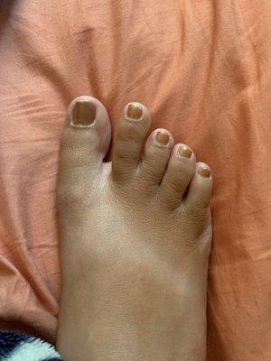 pedicure/ ingrown toe nail