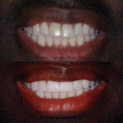 Implant crowns don't have to look different from natural teeth. It is challenging but it can be done here at BPDT!