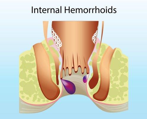 Fistula Maintenance