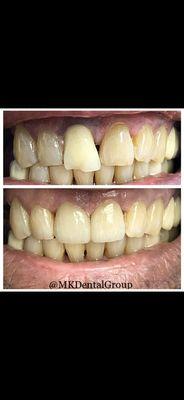 Veneers used to fix broken restoration and bring harmony and proper contour to our patients smile.