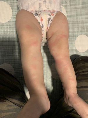 All over rash from food allergies