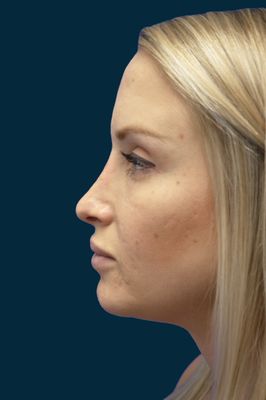 Rhinoplasty After