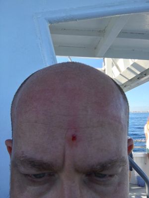 My forehead after the captain pulled the fishing linep