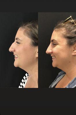 Non-surgical rhinoplasty (liquid nose job).