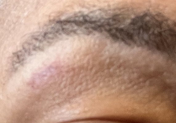 Welt from eye waxing