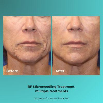 What radiofrequency microneedling can do for you!