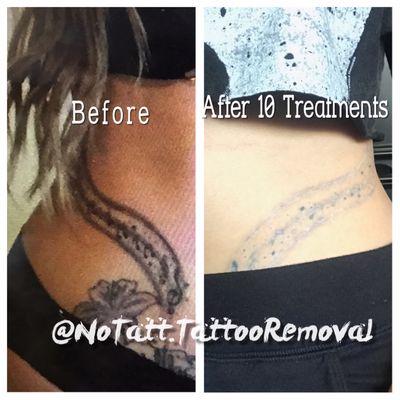 Before and after 10 tattoo removal treatments.