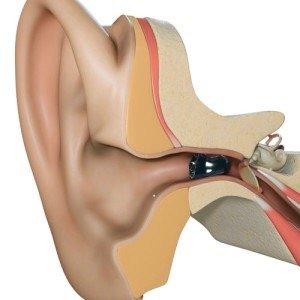 SoundLens Invisible Hearing Aid