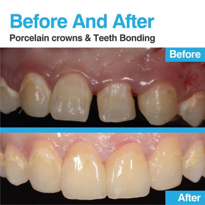 CASE #10: PORCELAIN CROWNS & TEETH BONDING  Would you like to schedule an appointment? Contact us and we will advise you:

(561) 279-699