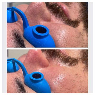 Before and after hydrodermabrasion treatment with oxygen infusion.