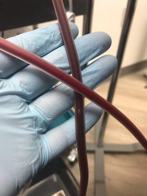 RHP procedure cleaning the blood. The dark line is the patients blood before cleaning and ozonating. Red blood is after.