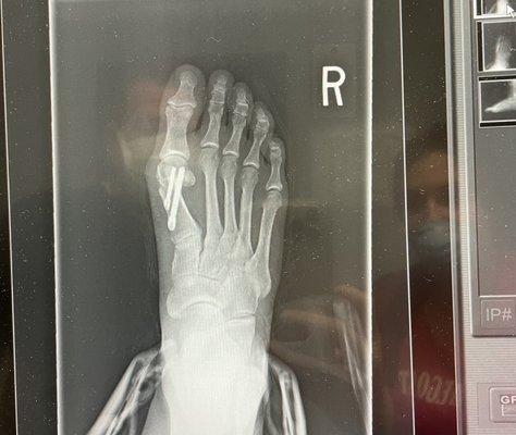 I still clearly have a bunion and those screws are huge!