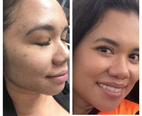 Before and after - one session or Microneedling with PRP