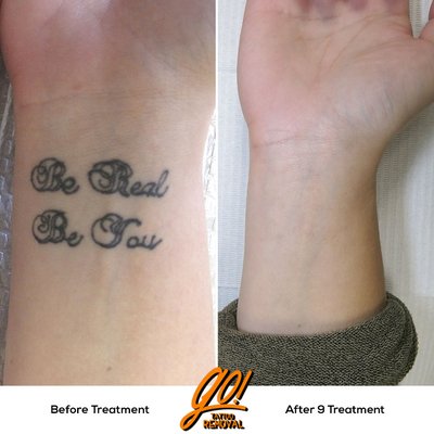 Wrist tattoo removed after 9 treatments.