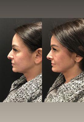 Non-surgical rhinoplasty (liquid nose job).