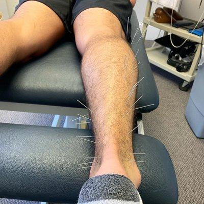 Dry needling can be an effective treatment alternative for chronic injuries that don't seem to get better with traditional therapies.